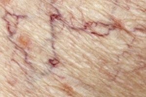 Spider Veins Treatments Alberta