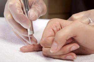 Wart Removal Edmonton