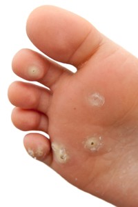 Wart Treatment Edmonton